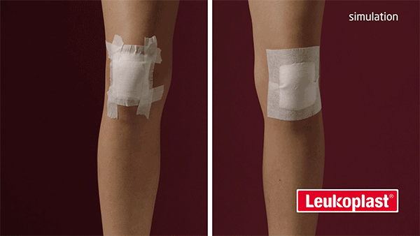 Close-up comparison of surgical tape vs wide area fixation performance on a bending knee over time Close-up comparison of surgical tape vs wide area fixation performance on a bending knee over time